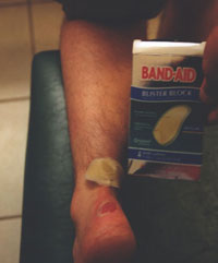 Bad blisters + False advertising = OUCH!